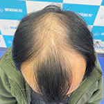 高端私定植髮
