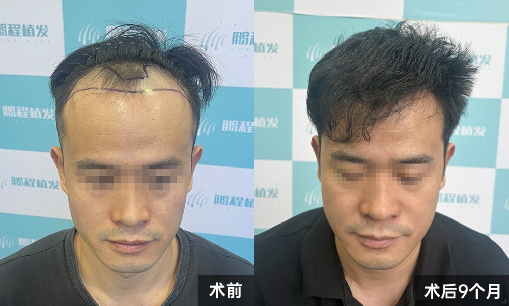 術後9個月｜前後對比，逆襲重生