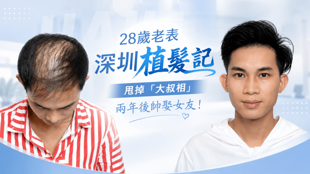 28歲廣西老表深圳植髮記：甩掉「大叔相」 兩年後帥娶女友！