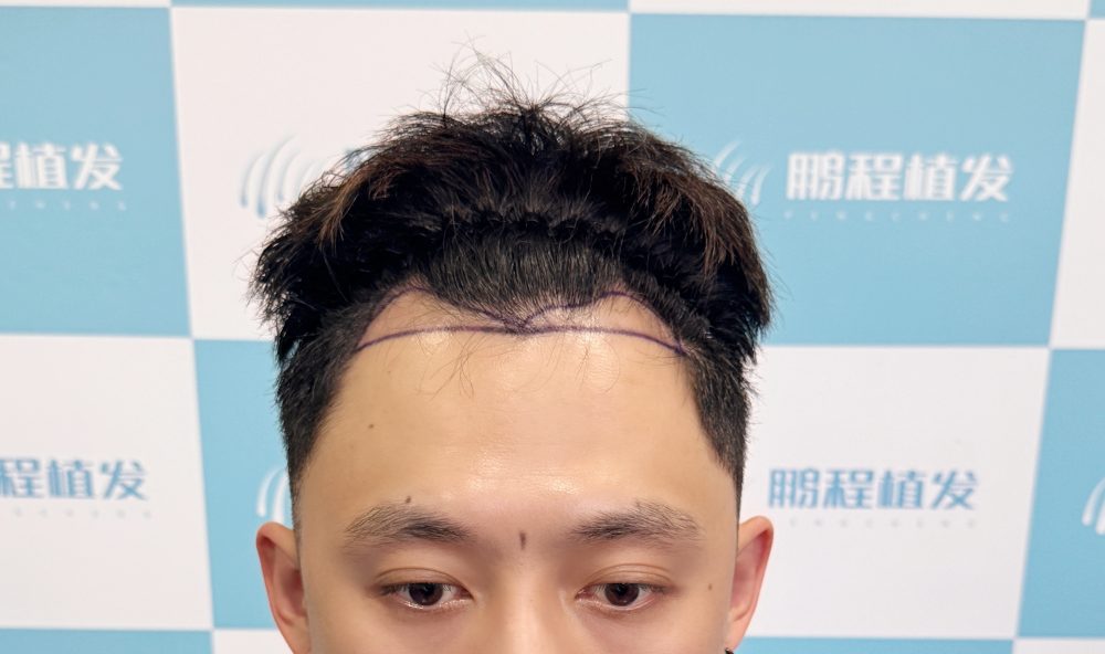 重塑自信從「頭」開始：男性髮際線深圳植髮的美學設計思路