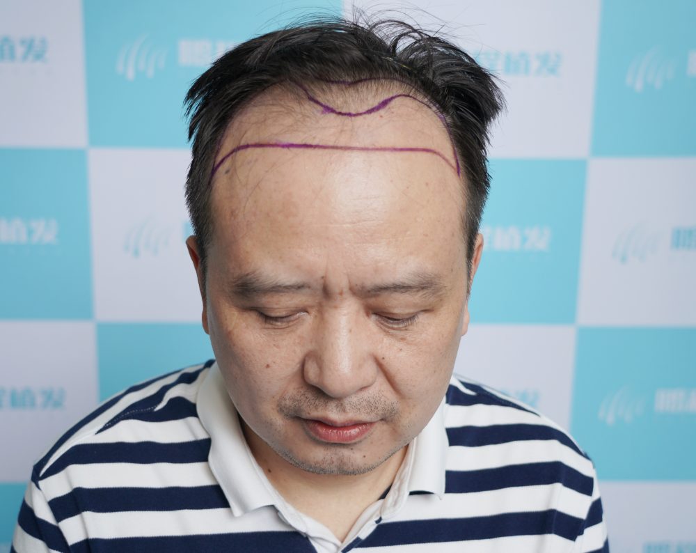脫髮救星：三分靠技術，七分靠方案——教你精準避開深圳植髮雷區