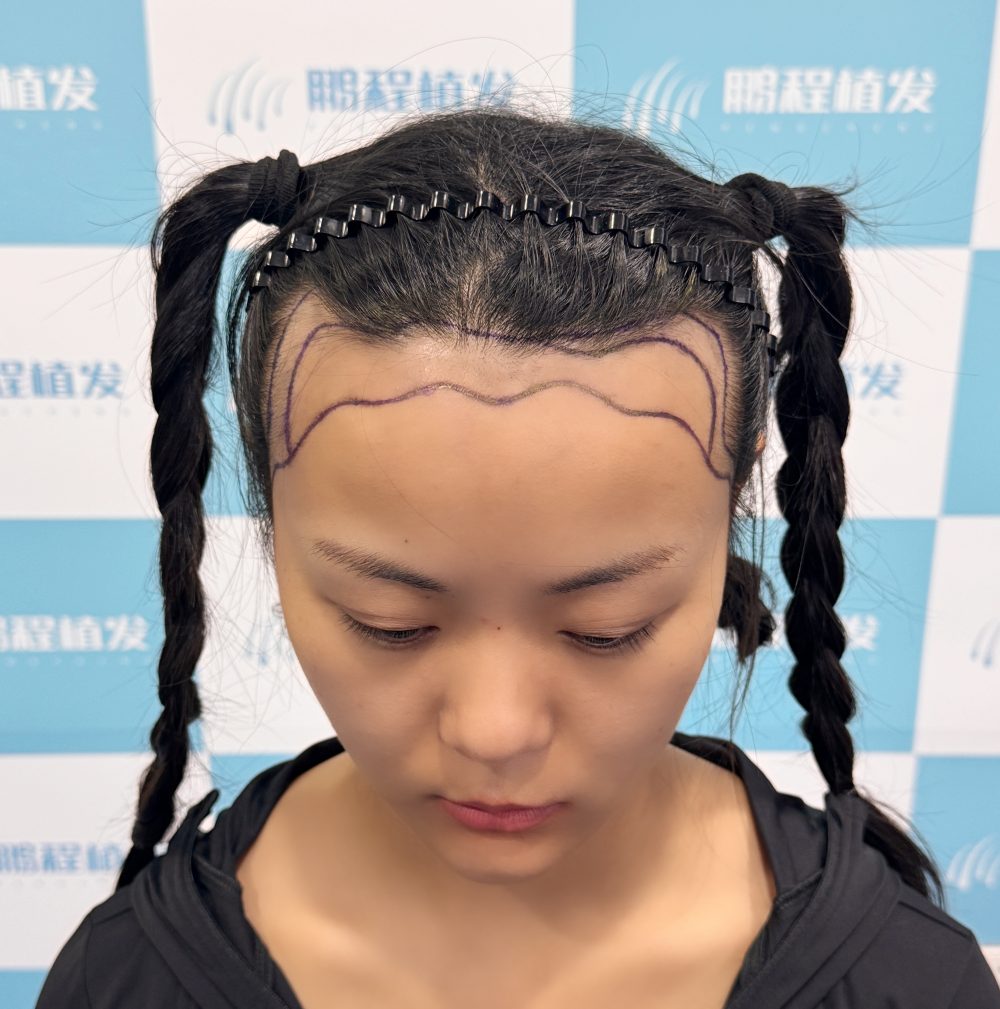 不敢在深圳植髮？讀完打消你的植髮疑慮