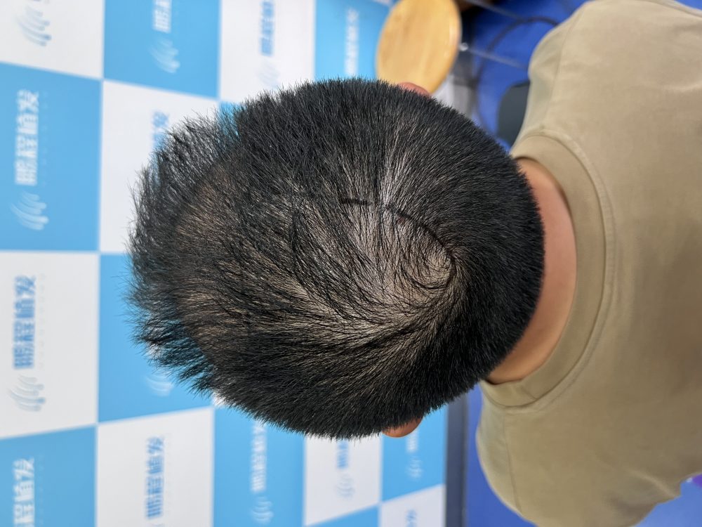 深圳植髮手術為什麼這麼貴？從成本結構看價格組成