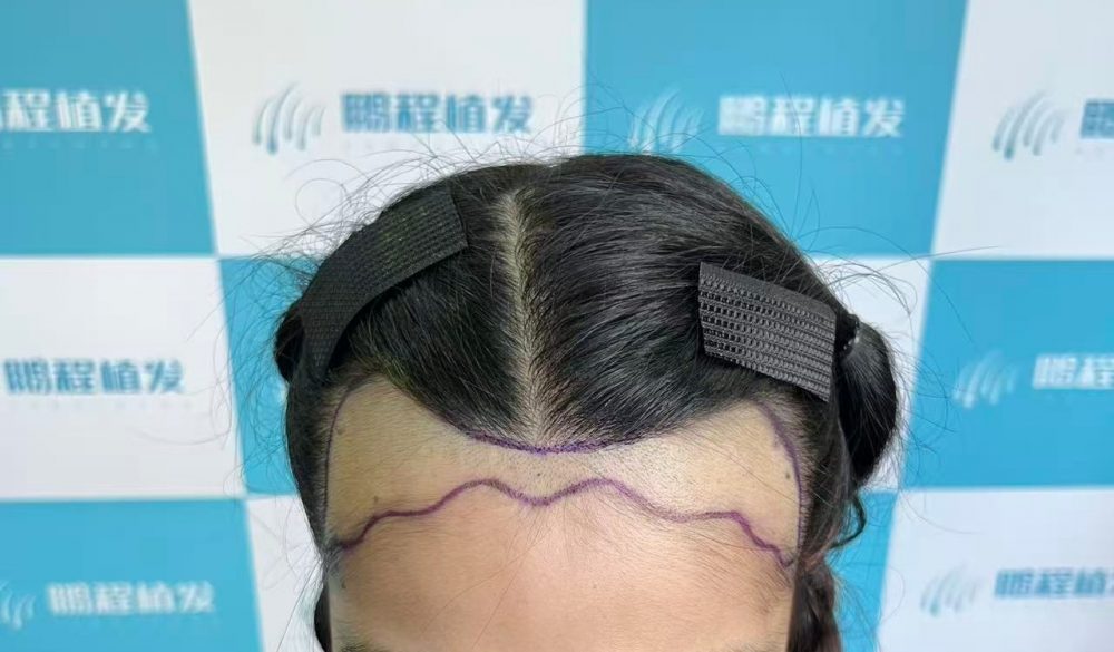 把握夏季深圳植髮黃金檔！不僅恢復快，更能完美避開秋冬尷尬期
