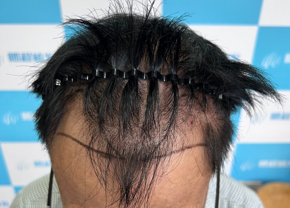 深圳植髪手術怎麽判斷成功還是失敗？
