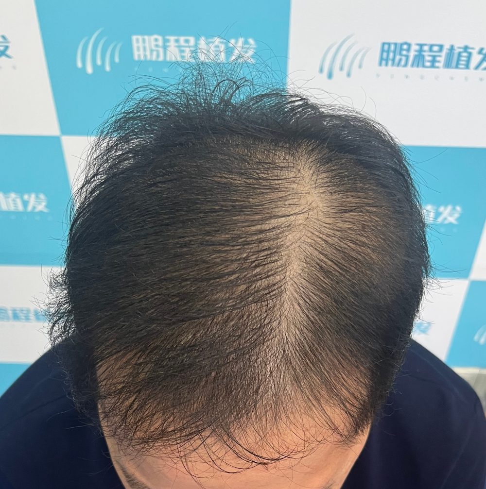 深圳植髪內幕：這三類人植髪堅決勸退！