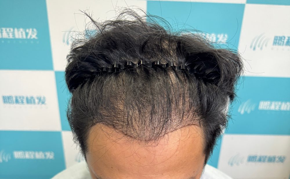 M字額一定要深圳植髮嗎？解析早期干預與非手術生髪體系的協同效應