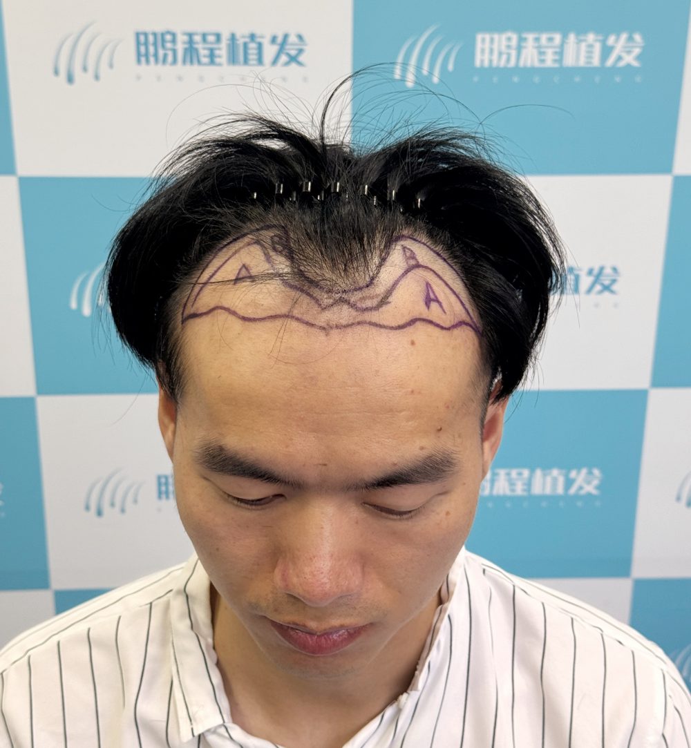 深圳植髮後頭髮能維持多久？會唔會一兩年就掉光？