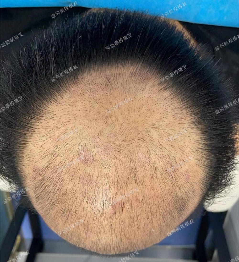 40歲香港金融男士解決雄激素脫髪：從禿頭到青絲複密，只需三個月！