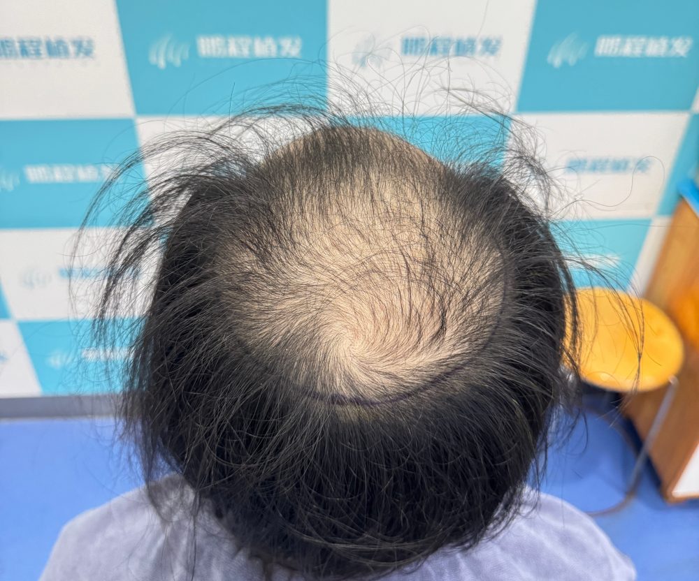 頭頂髮量告急，去深圳植髮加密會不會傷害原生髮？