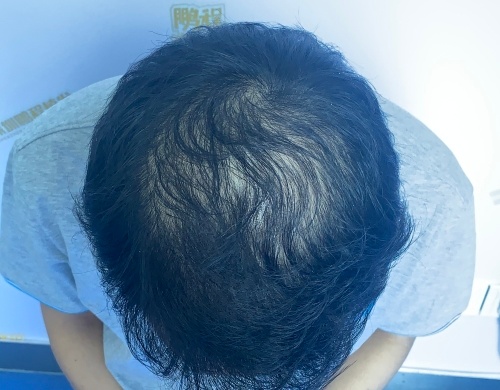 為何男人一到中年，就難逃「地中海」脫髮命運？深圳鵬程植髮線上解答