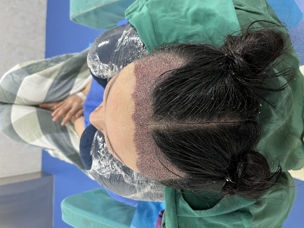 深圳植髮技術怎麼選？FUE、微針、不剃髮全方位解析