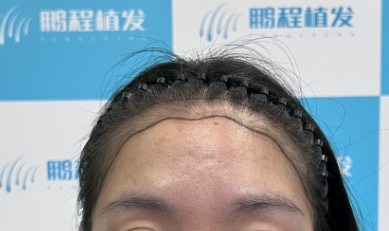 - 髮際線設計 - 1