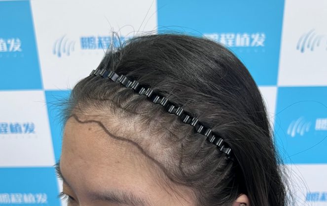 - 髮際線設計 - 3