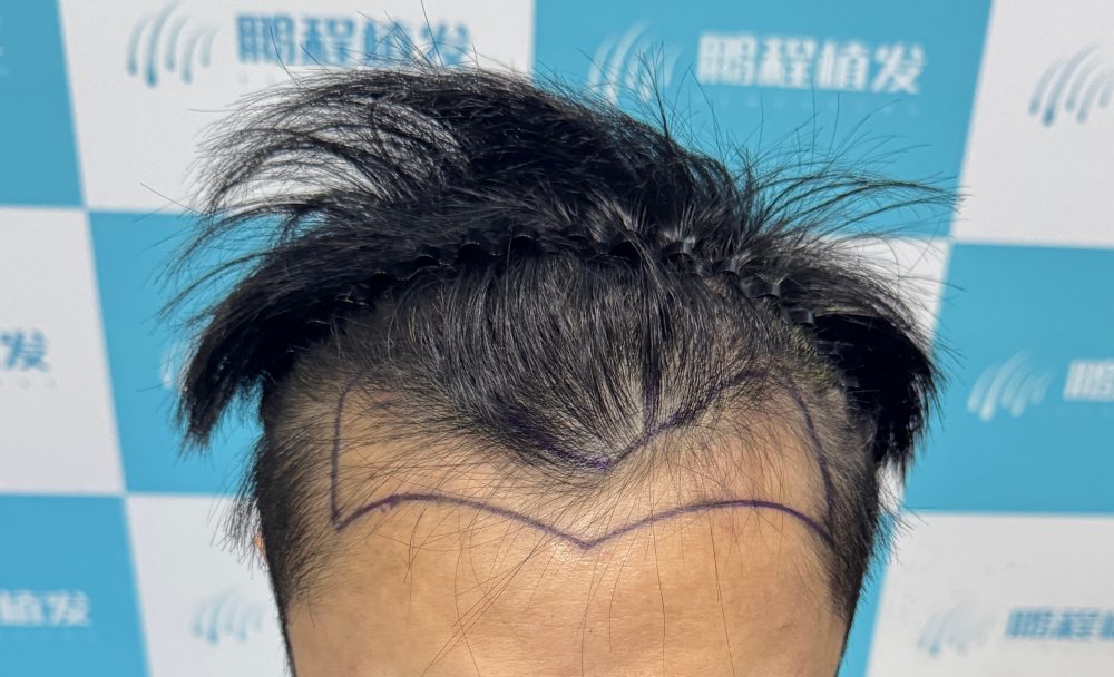 深圳植髮術後會經歷幾個階段？最終效果要等幾耐先穩定？