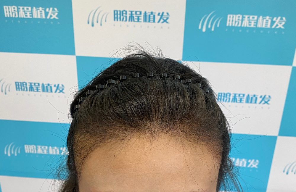 深圳植髮後3個月沒效果等於白做？其實效果有滯後性！
