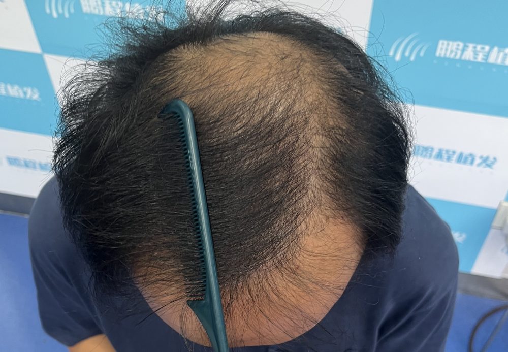 雄脱用藥好還是非手術生髮好？深圳鵬程植髪教妳3個關鍵判斷標準