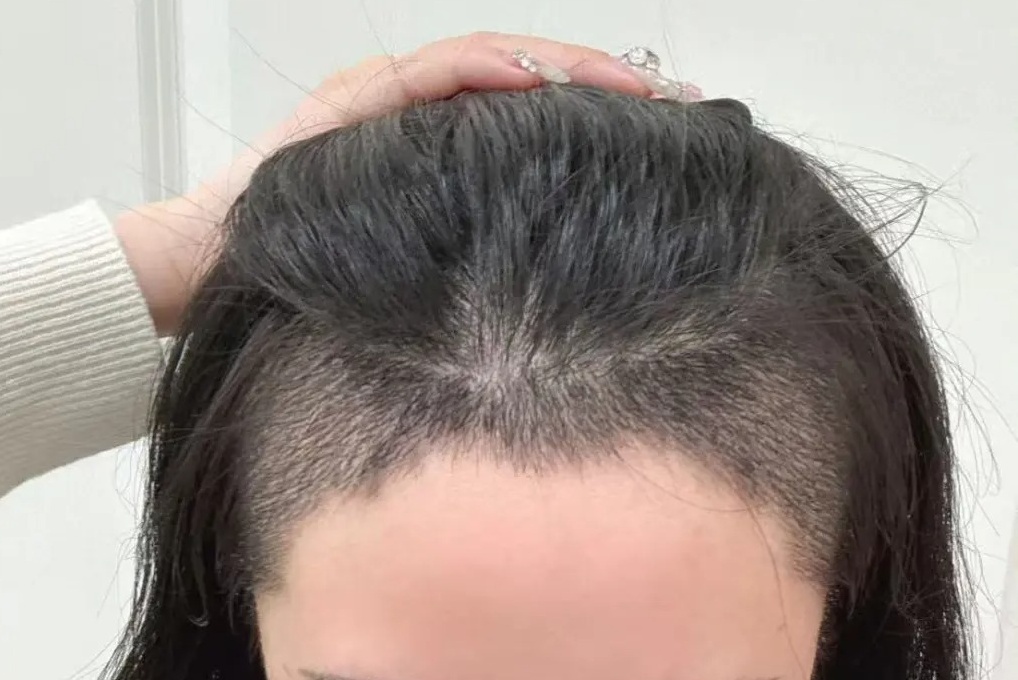 為什麼很多人用了脱髮藥，最後還是要做深圳植髮？