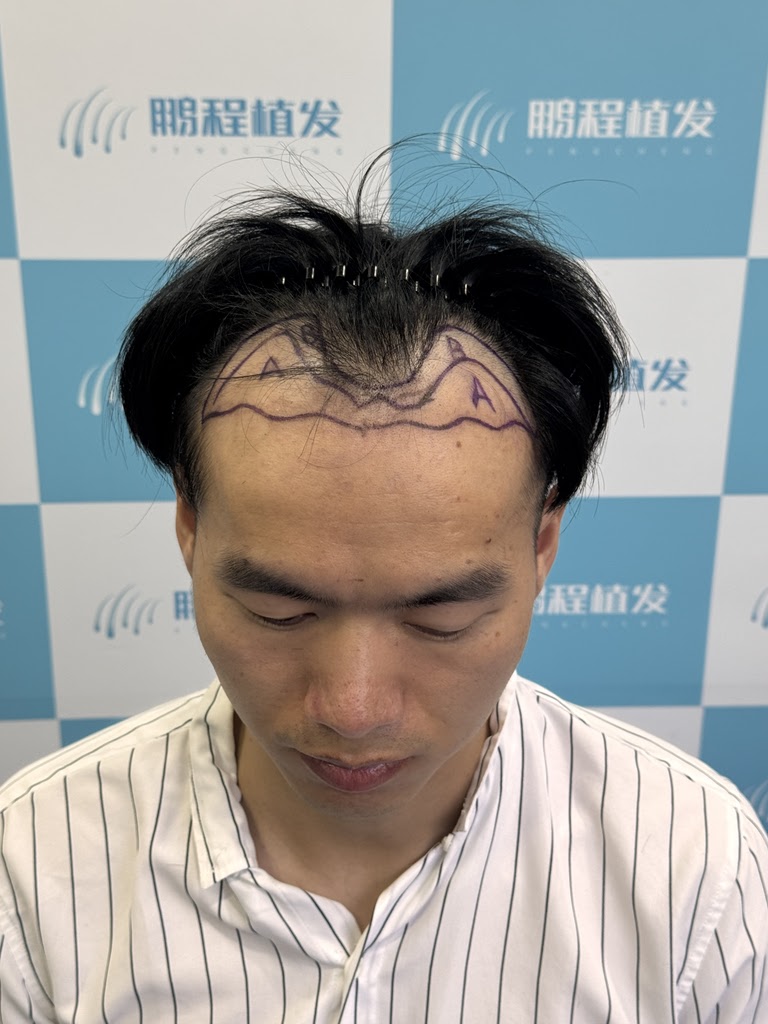 【深圳鵬程植髮解答】男士雄脱為什麼總先禿M角與頭頂？