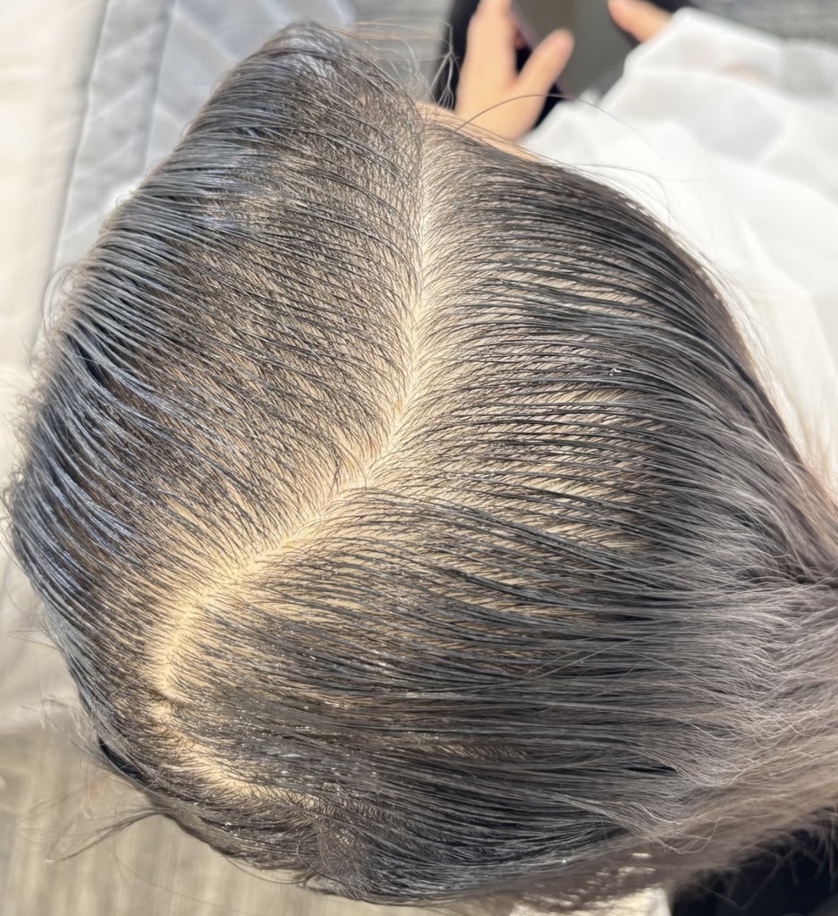 頭油頭癢頭皮屑反覆？ 深圳鵬程植髮提醒：可能是你的頭皮微生態響警號