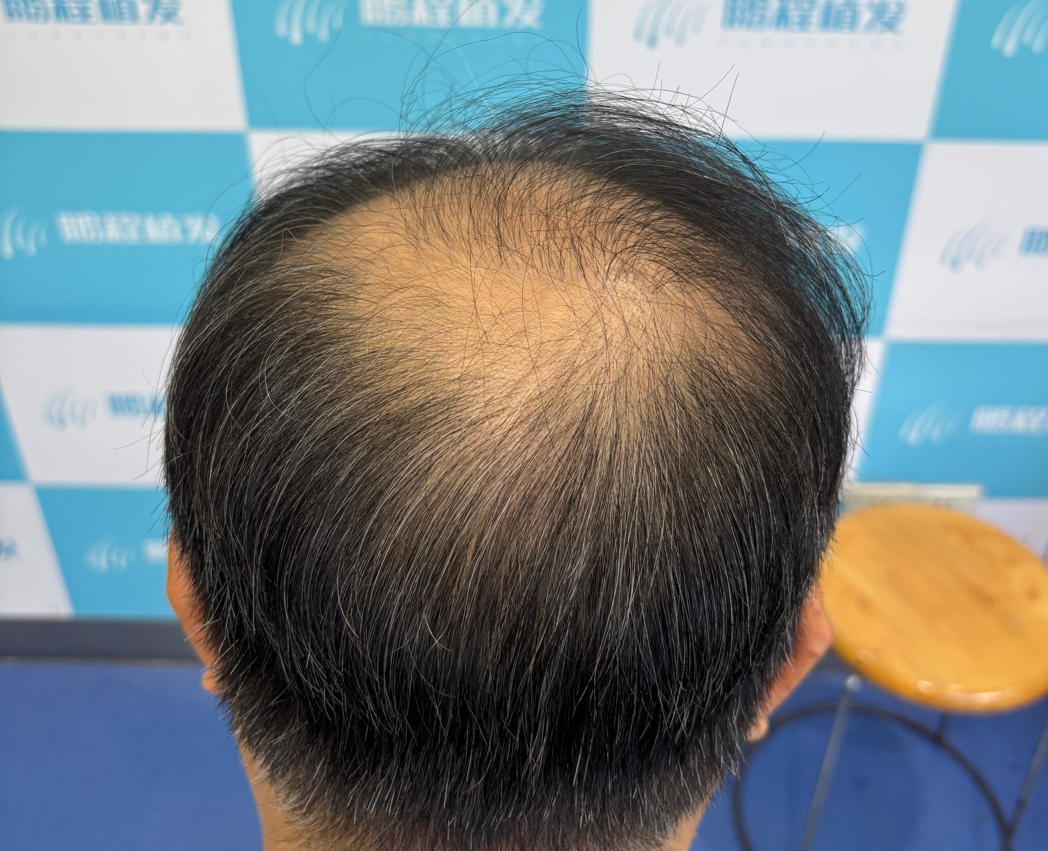 脫髮找不到病因？深圳鵬程植髮提醒：放任不管真會禿頭！