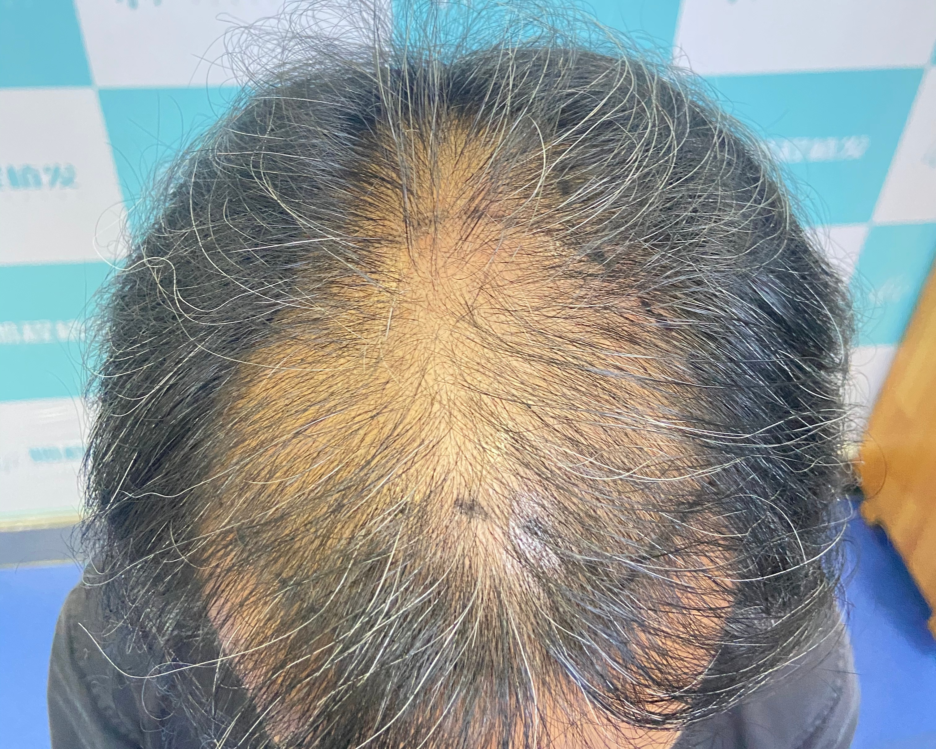 脱髪別亂治！從頭頂稀疏到自然濃密，一文了解防脱＋深圳植髪完整方案！