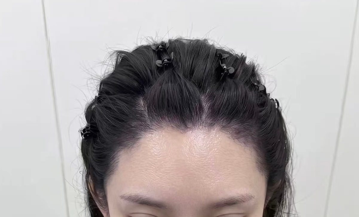 深圳植髮術後效果到底可以維持多久？