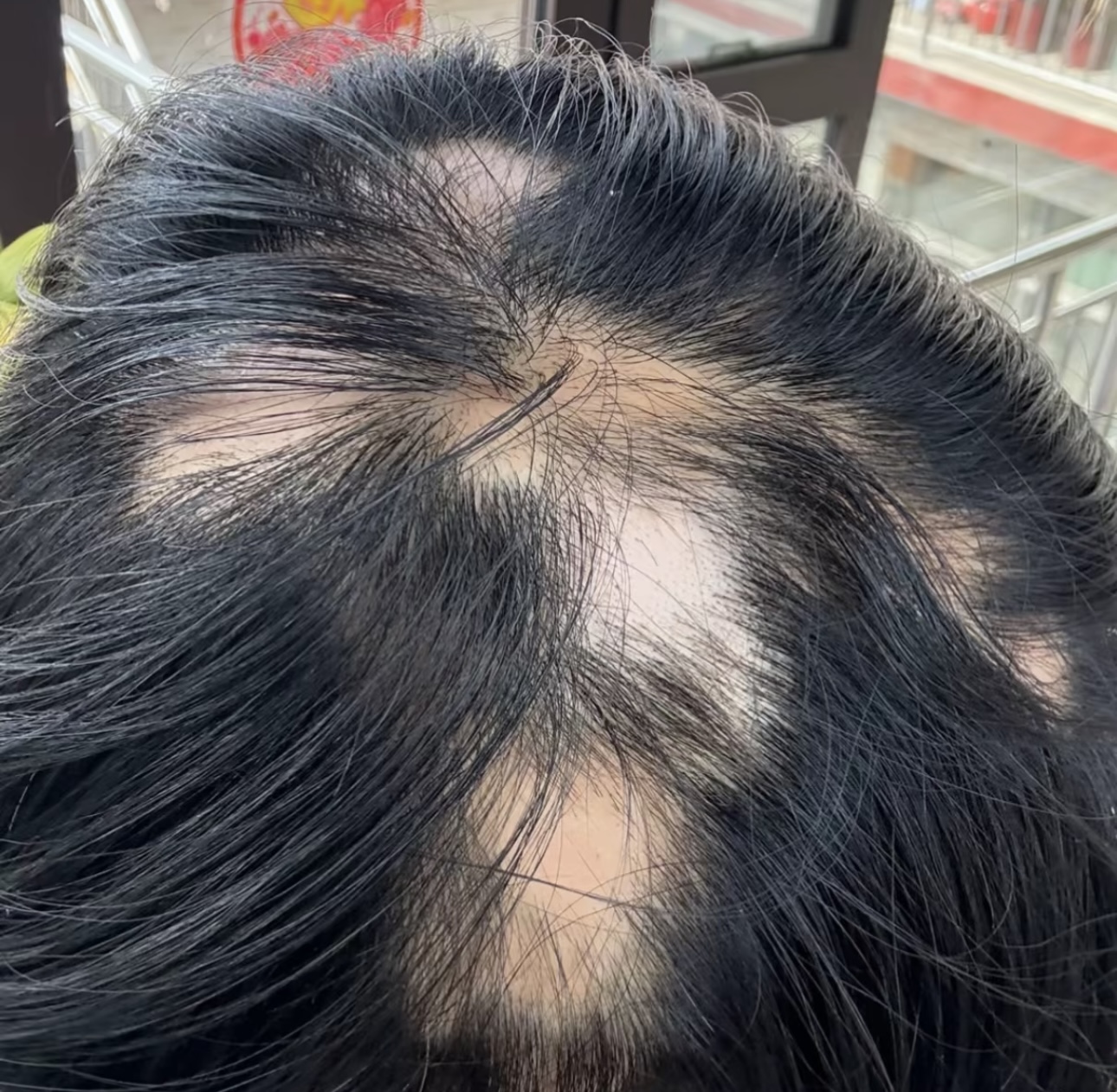 頭上突然禿幾塊是「鬼剃頭」嗎？需要深圳植髮嗎？