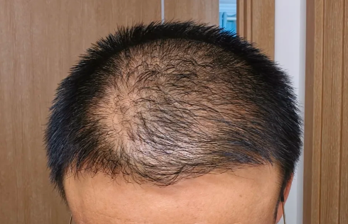 破壞毛囊的元兇究竟是什麼？深圳鵬程植髮在線解密！