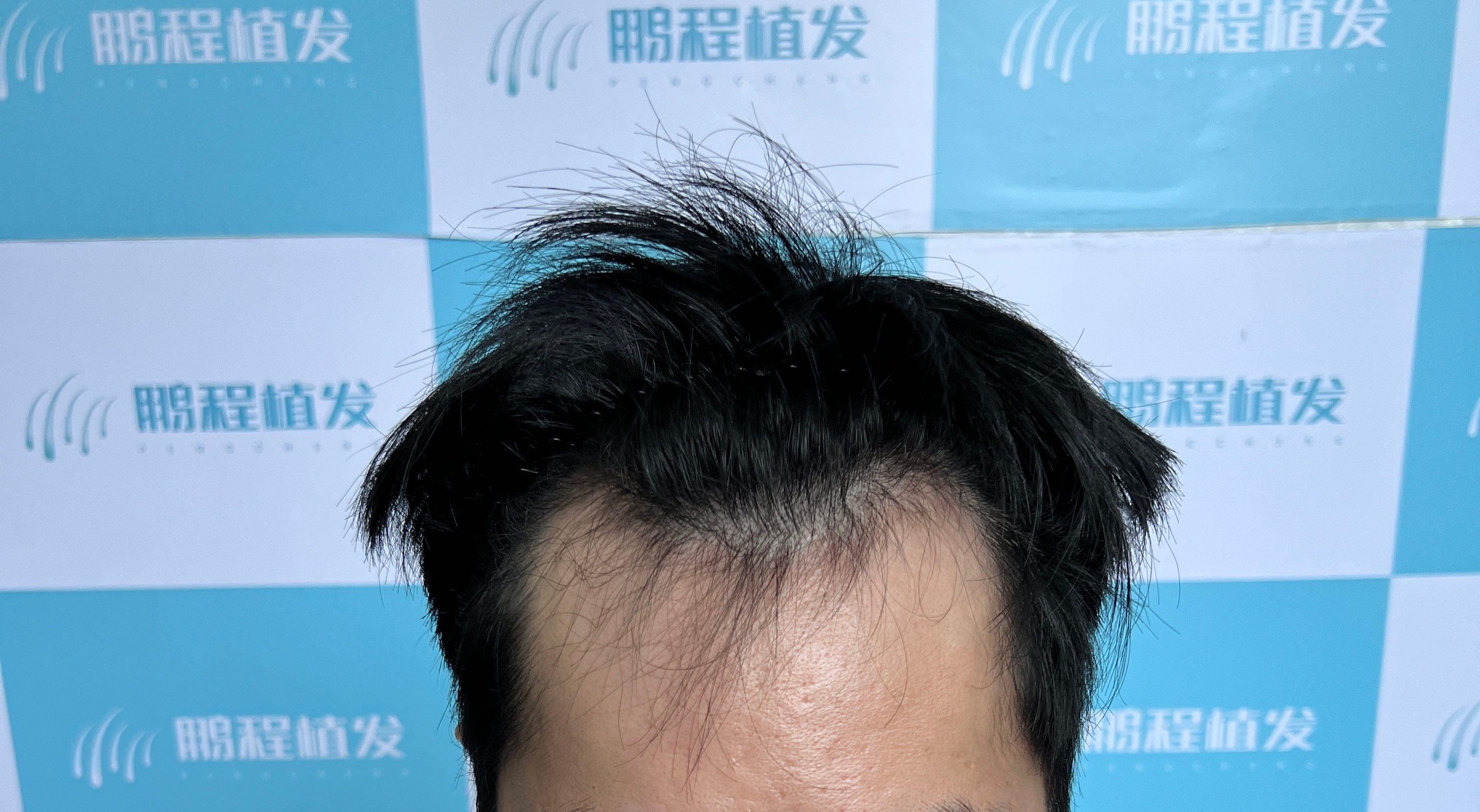 秋季在深圳植髮，效果真的更好嗎？